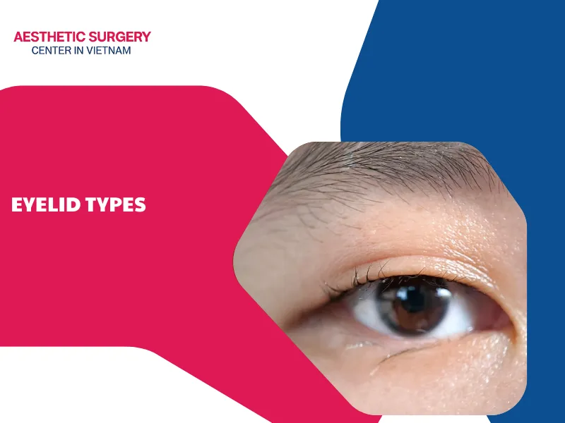 eyelid types