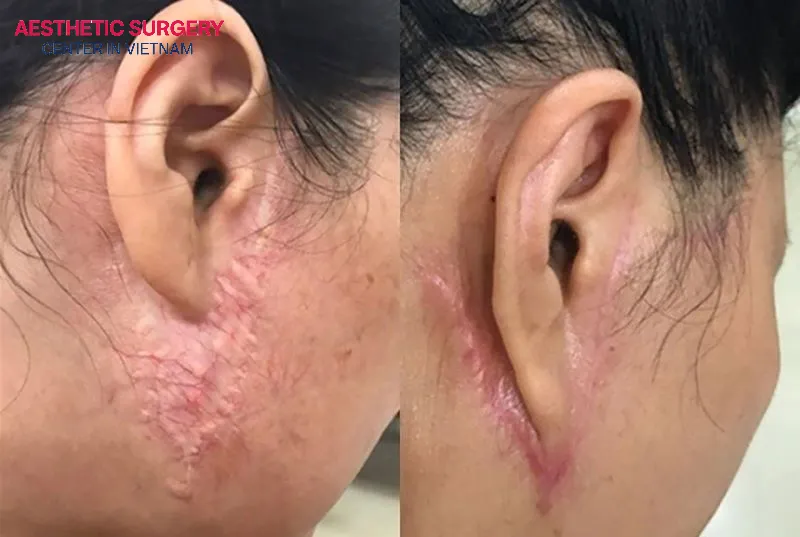 Facelift scars are normal after surgery, and they will gradually fade over time.