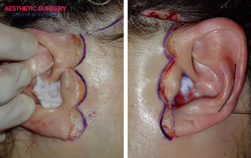 In the early stage after surgery, the treated area is often swollen and bruised.