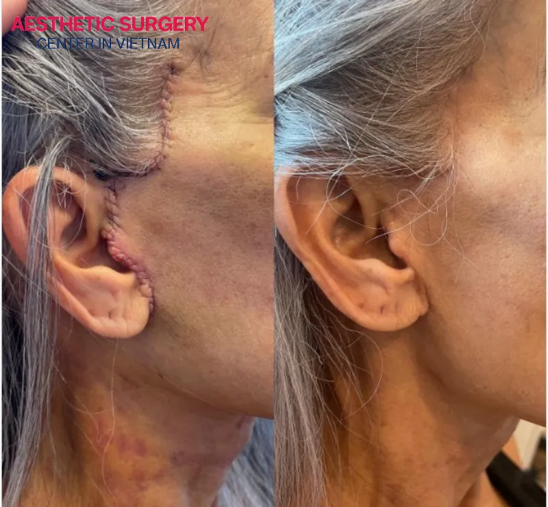 After about 6 months, the scar will gradually fade.