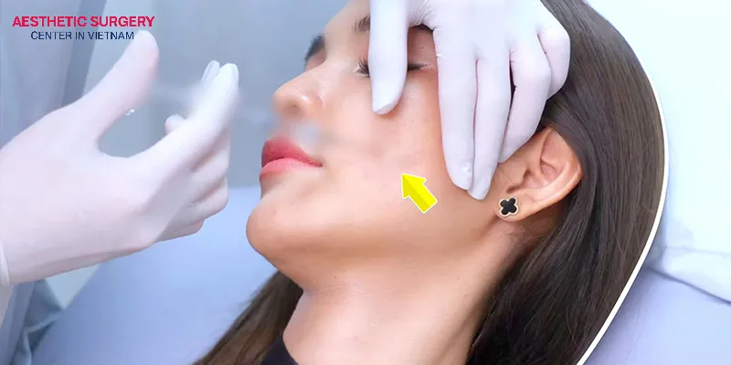 Steroid injections are a suitable option for Individuals who develop keloid scars after facelift surgery.