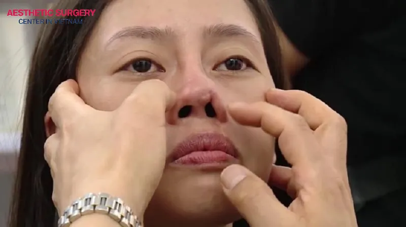 A flat nose can be caused by complications or mistakes from a previous rhinoplasty.