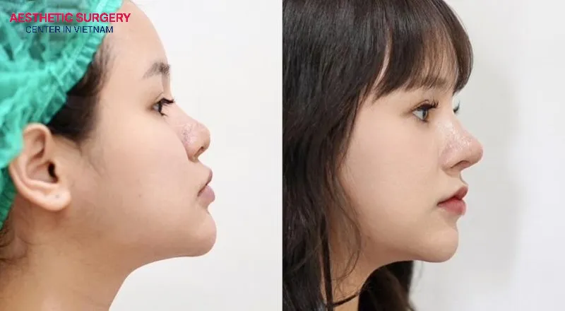 Flat nose rhinoplasty not only improves appearance but also creates better facial harmony.