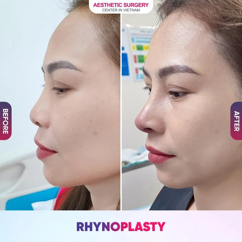 Before-and-after photos of patients who had flat nose rhinoplasty at Aesthetic Surgery Center In Vietnam.