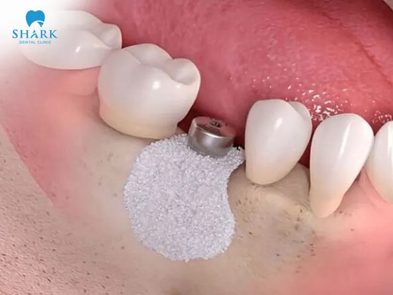 You can choose between autogenous bone grafts or allogeneic bone grafts depending on your condition