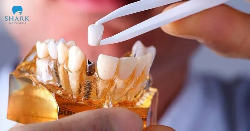 Dental implant placement helps restore chewing ability and maintain stable aesthetics for teeth over time