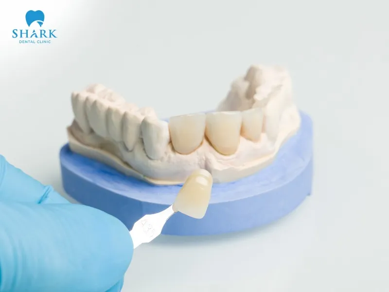 Porcelain veneers offer greater durability and longevity compared to composite veneers