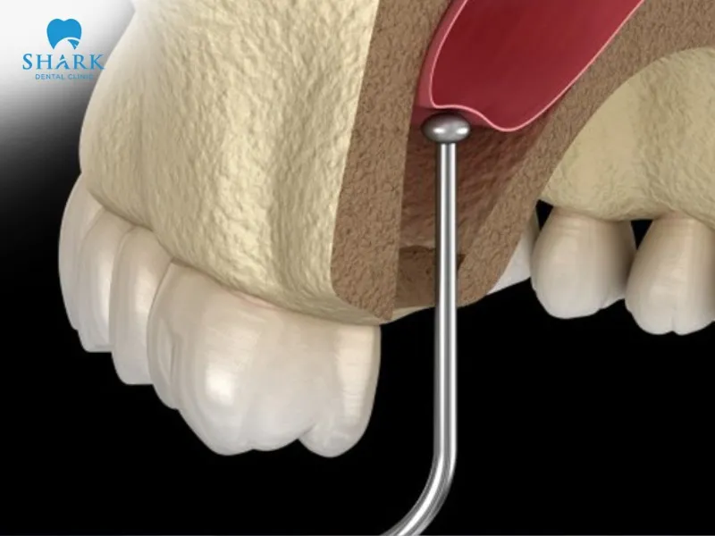 A sinus augmentation is suitable for cases of long-term tooth loss, thin jawbone, or insufficient bone volume