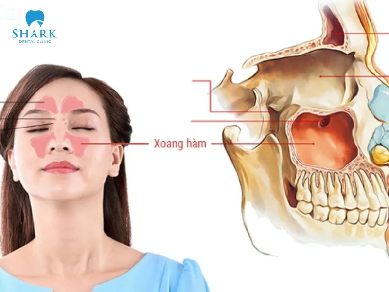 There are two sinus augmentation techniques: closed sinus lift and open sinus lift