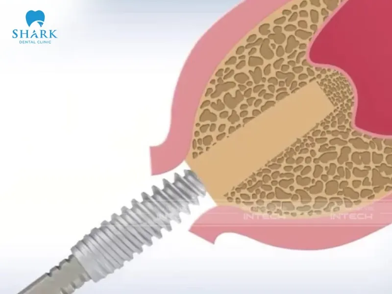 Artificial bone, autogenous bone, and allogeneic bone can be used for sinus lift procedures