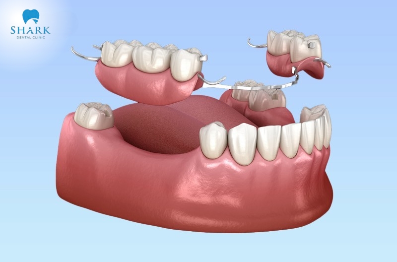 Partial restoration with removable dentures