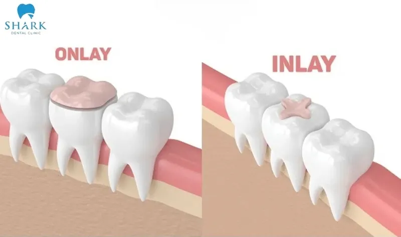 Inlay and onlay fillings offer many outstanding advantages in dental restoration
