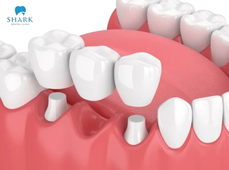 Porcelain dental bridges come with a reasonable treatment cost, making them suitable for a wide range of patients