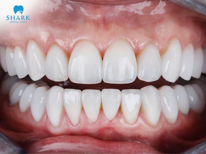 The lifespan of cosmetic dental crowns typically ranges from 10 to 20 years or longer, depending on individual cases