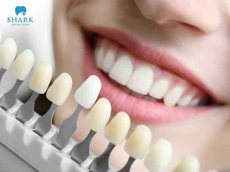 Aesthetic porcelain crowns feature excellent biocompatibility and superior aesthetics