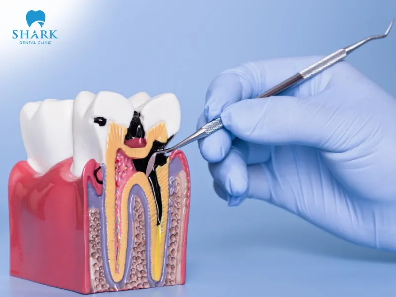 After a period of using low-quality porcelain crowns, there is a higher risk of tooth decay, periodontitis, gingivitis, and other oral health issues