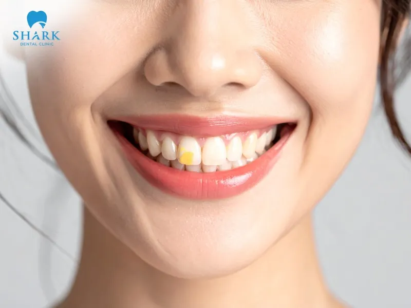 Discolored or yellowish teeth can be significantly improved through aesthetic porcelain crown treatment