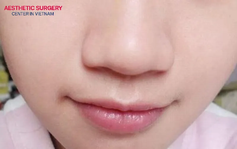 Individuals with a large, thick nasal tip and wide, flared nostrils are ideal candidates for small rhinoplasty.