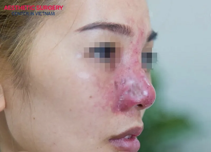 Reduction rhinoplasty performed at a low-quality facility or with surgical mistakes can lead to nasal infection.