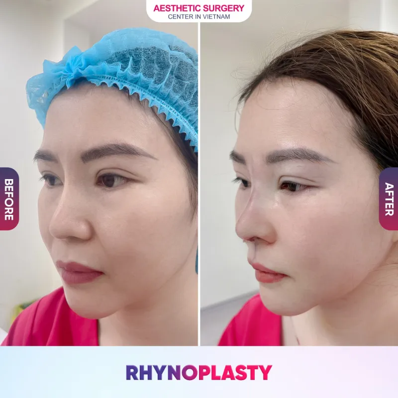 Customer before and after images of nose reduction surgery at Aesthetic Surgery Center In Vietnam.