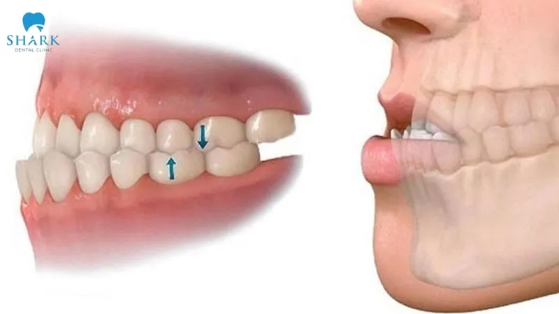 Bite rehabilitation effectively improves chewing function and supports long-term oral health