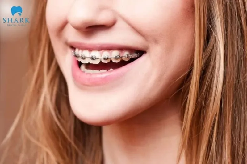 Orthodontic treatment (braces) is one of the bite rehabilitation methods used to correct protrusion, underbite, or crowded teeth