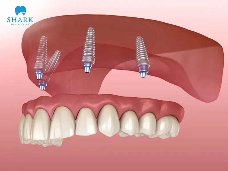 All-on-4 dental implants effectively limit the process of jawbone loss