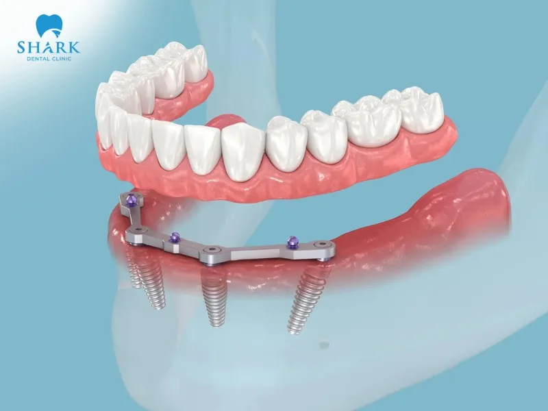 The cost of All-on-4 dental implant is higher than that of traditional tooth replacement methods