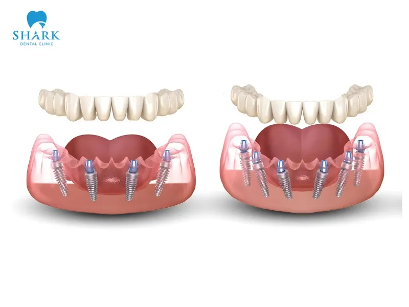 All-on-4 dental implant are more affordable compared to the All-on-6 technique