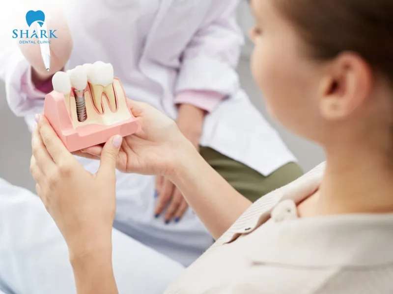 The cost of All-on-4 dental implant treatment ranges from 160,000,000 to 240,000,000 VND per arch, depending on each case
