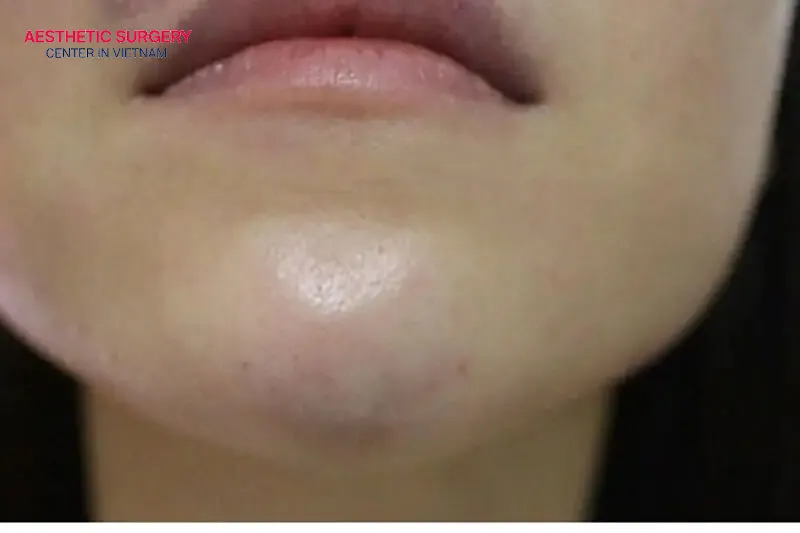 Washing your face incorrectly can cause bruising under the skin in the treated area.