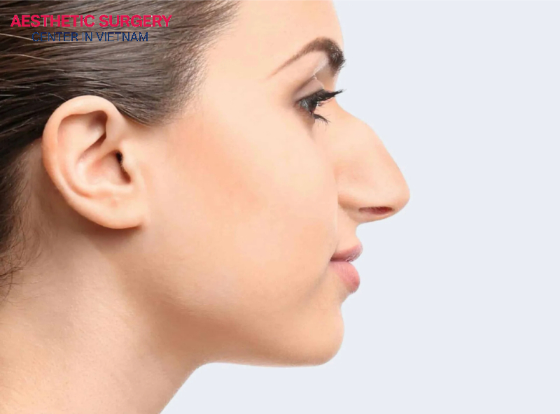 A dorsal hump is a raised bump that creates a convex curve on the nasal bridge.
