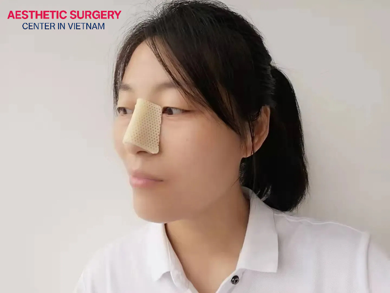 Your nose will be secured with an external splint after surgery.