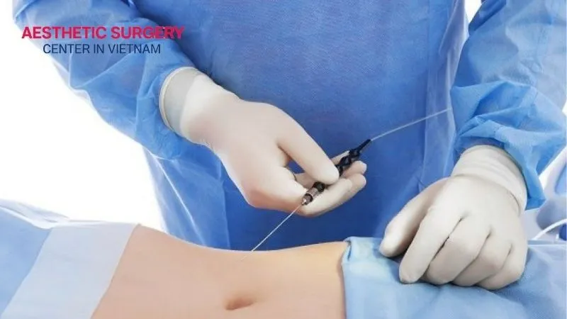 Standard medical back liposuction procedure