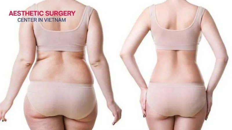 Back fat liposuction significantly reduces stubborn fat and improves body contour.
