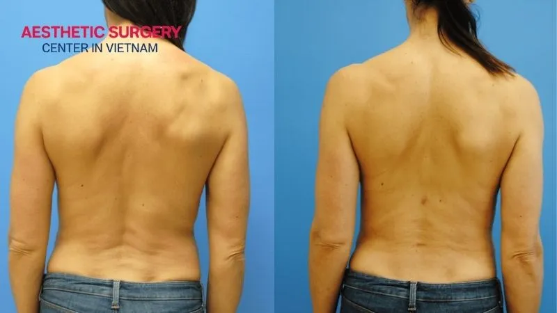 Visible results after back fat liposuction