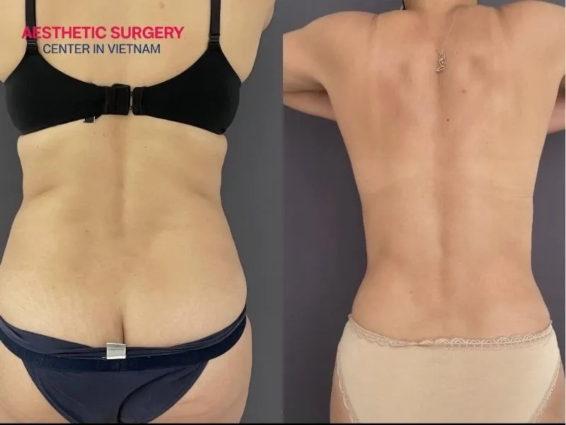 Restore natural body curves after back fat liposuction with minimal scarring