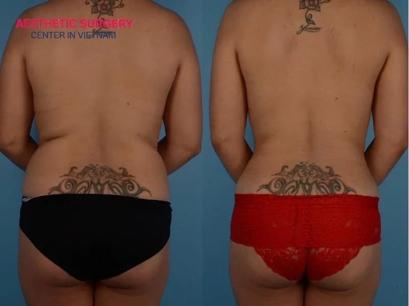 Clearly redefine natural body contours