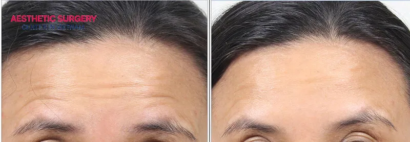 Botox for forehead wrinkles uses Botulinum toxin type A to relax the forehead muscles that cause wrinkles.