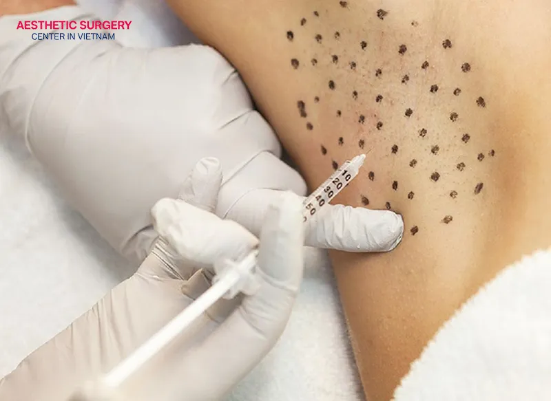 After 9 to 12 months, Botox gradually loses its effect and you will need repeat injections.