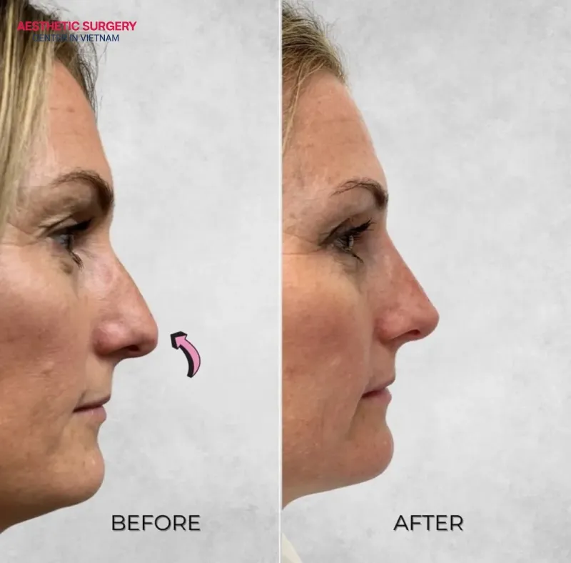Botox can slim the nose without surgery.
