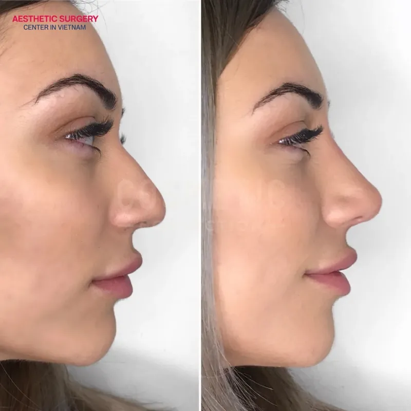 You have a low nose tip, wide nostrils, and want a quick, non-invasive solution.