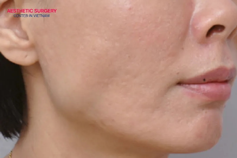 Flying too soon after botox may cause serious risks.