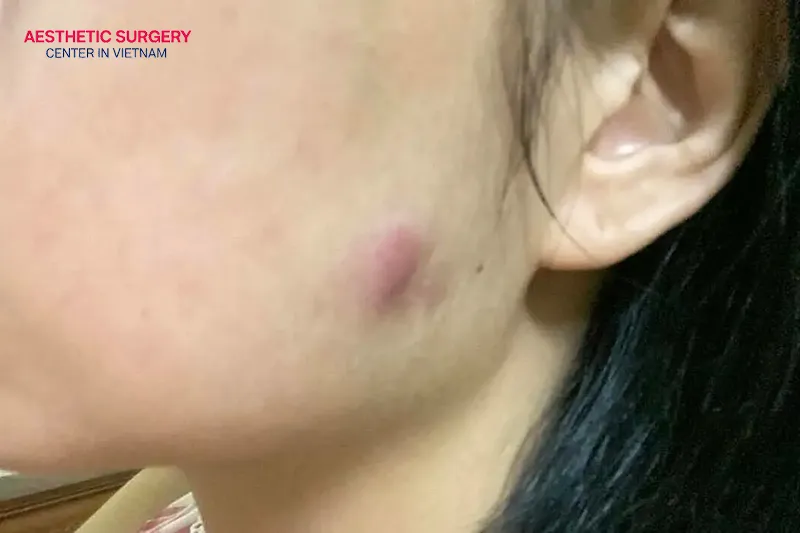 Bruising and swelling at the treated area may occur when flying because the injection sites have not fully healed.