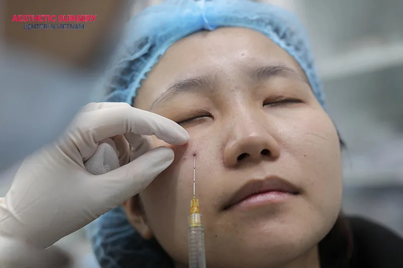 Filler under eye can improve dark circles, deep tear troughs, and hollow under-eyes.