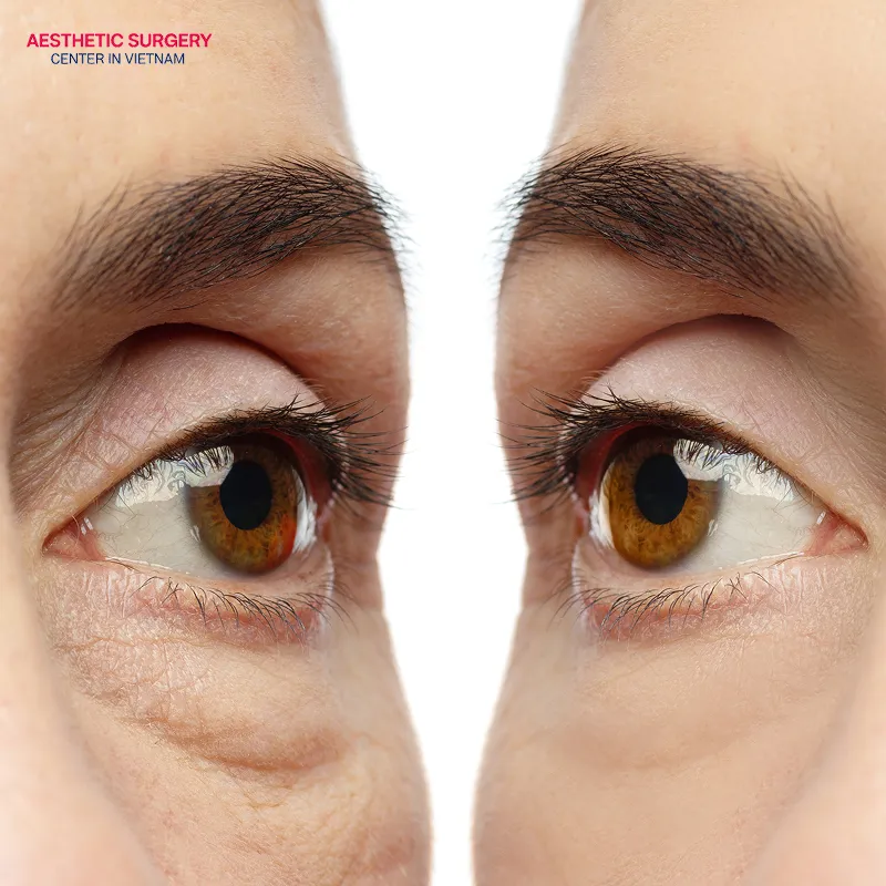 The results of filler under eye can last from 9 to 18 months.
