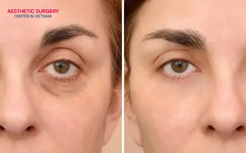 Dark circles and under-eye hollows improve significantly.