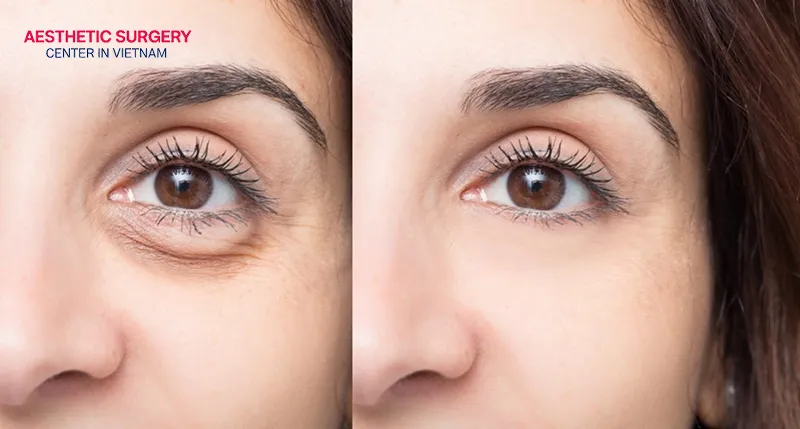 Say goodbye to dark circles and eye bags after filler under eye injections.