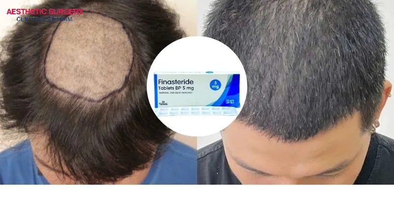 You should use Finasteride after a hair transplant to maintain the results.