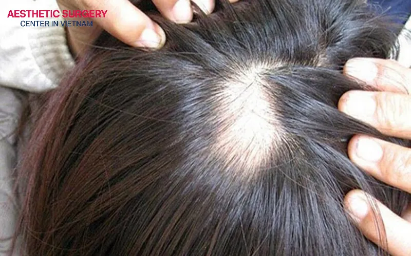 Without using Finasteride, the “island effect” can easily occur, making the hair look unnatural and aesthetically unbalanced.